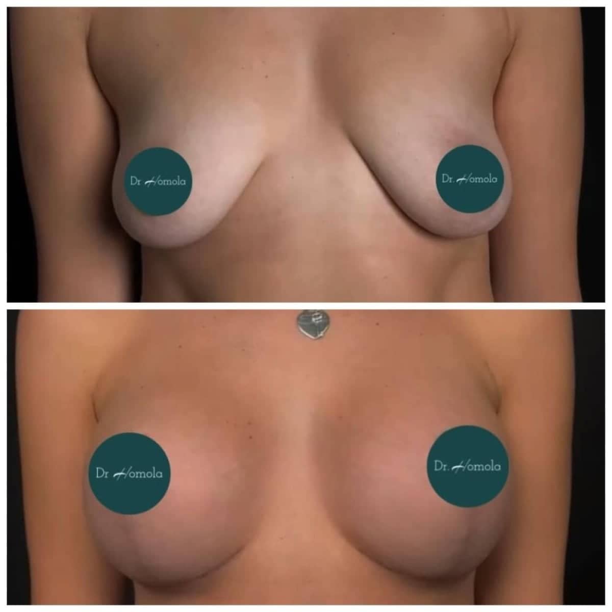 Case 14769 - breast lift