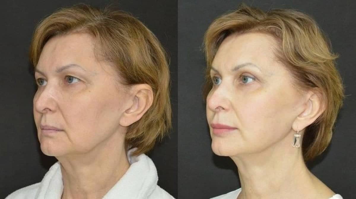 Case 14773 - upper eyelid surgery