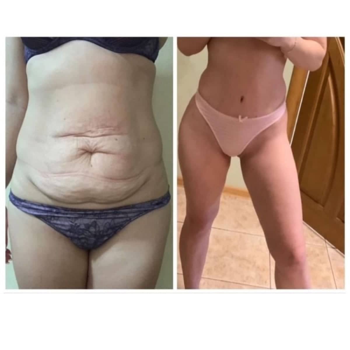 Case 14775 - tummy tuck and liposuction