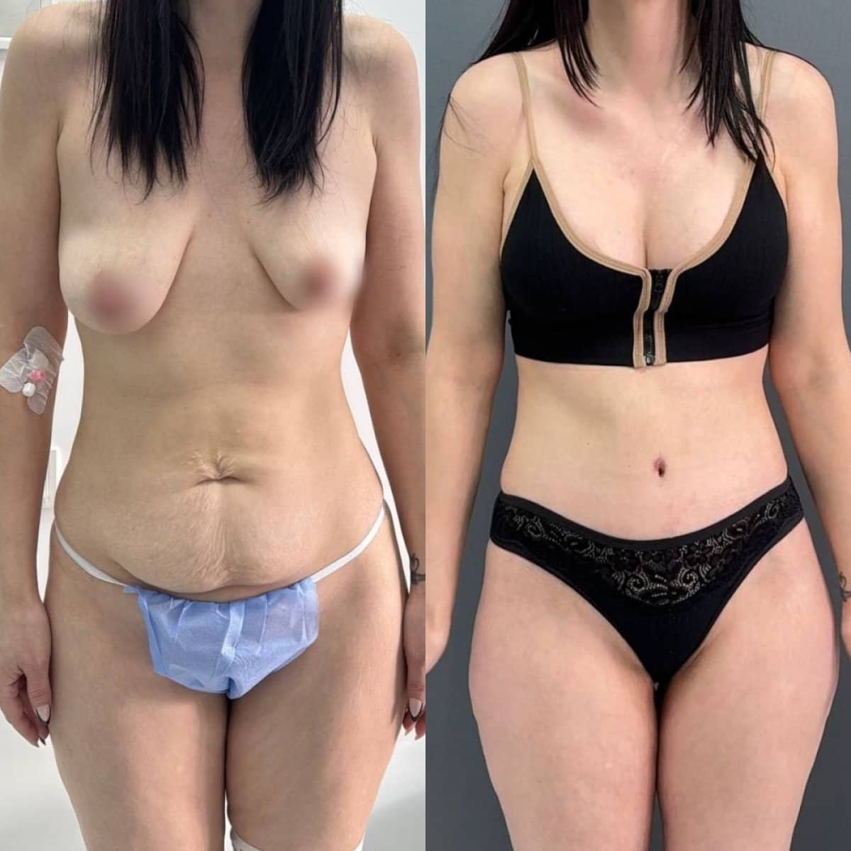 Case 14779 - breast lift