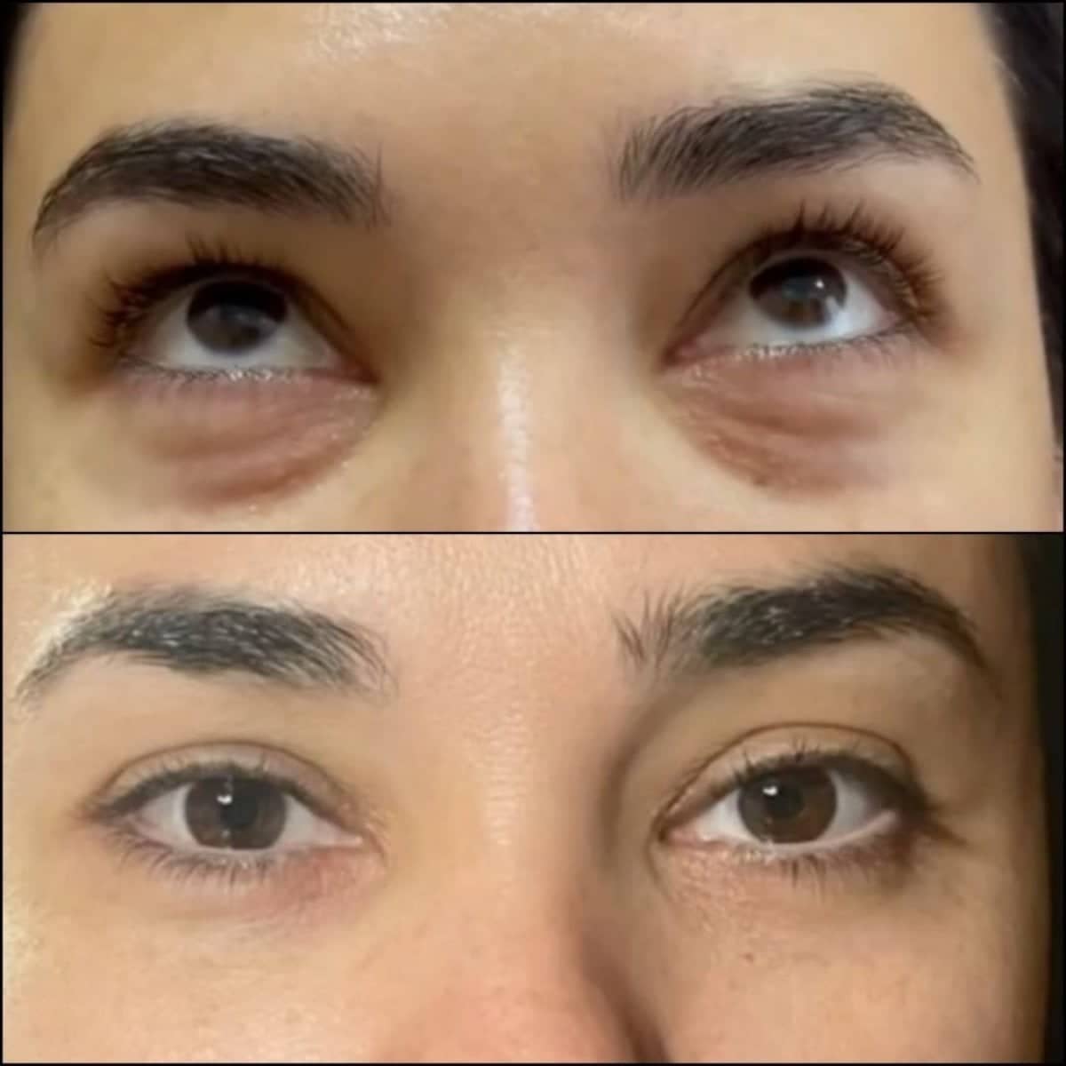 Case 14781 - upper eyelid surgery