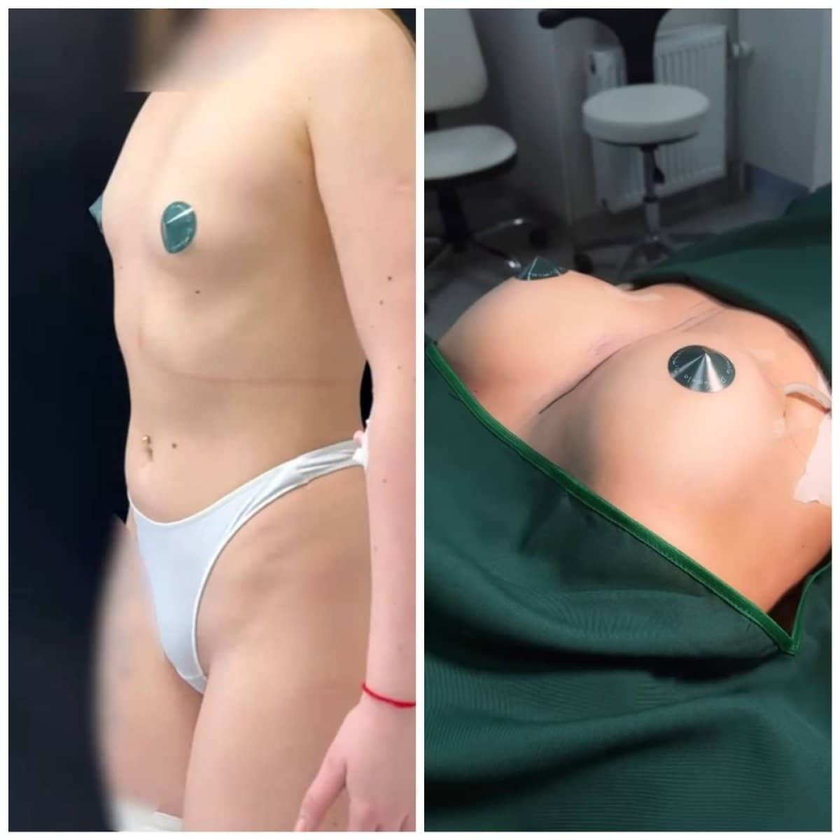 Case 14784 - breast lift
