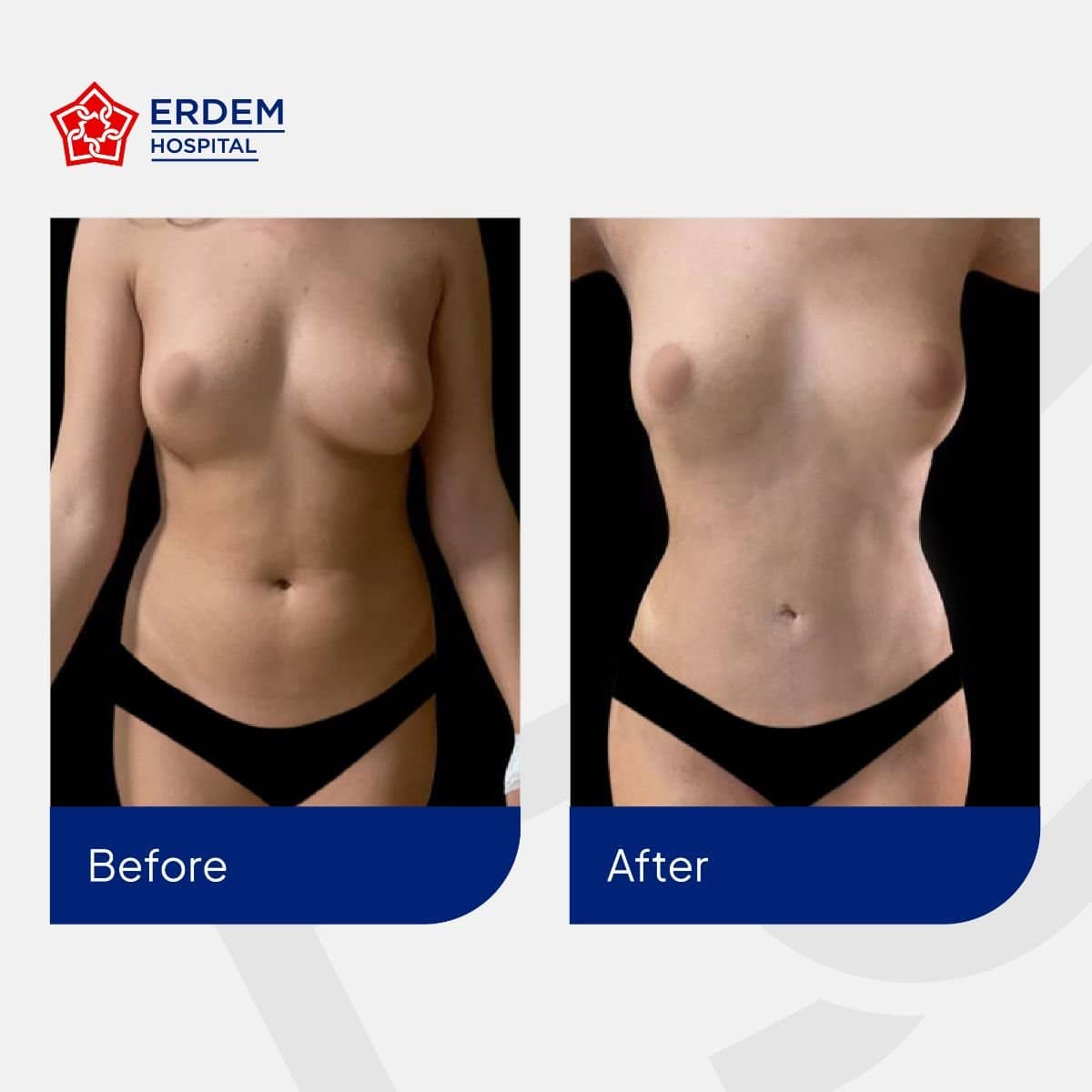 Case 14792 - tummy tuck and liposuction