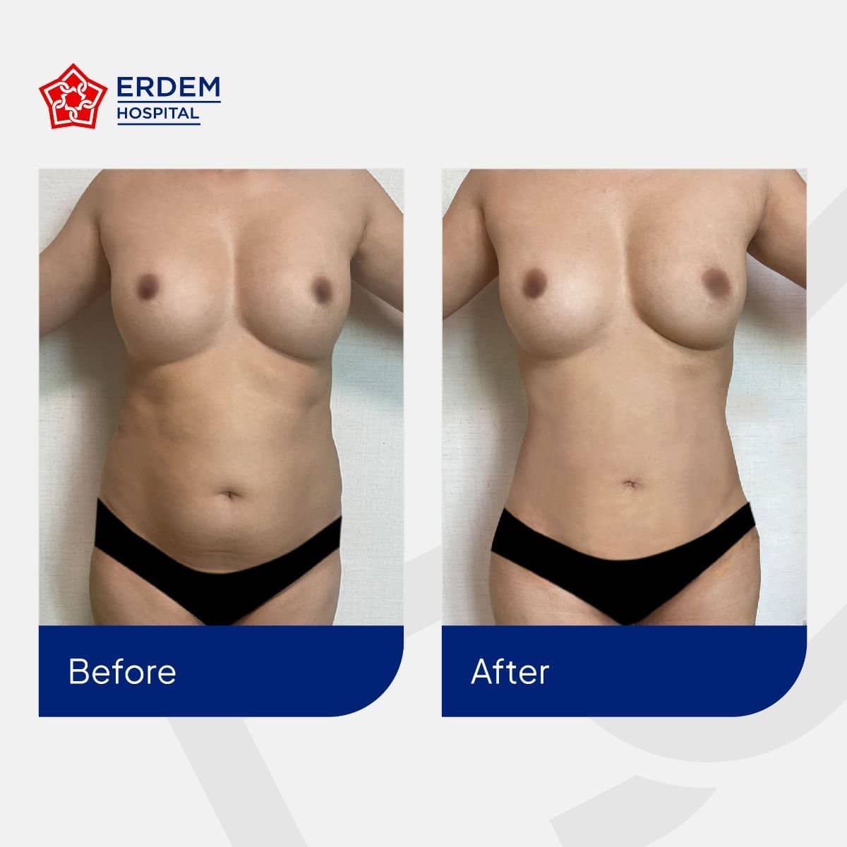 Case 14795 - tummy tuck and liposuction