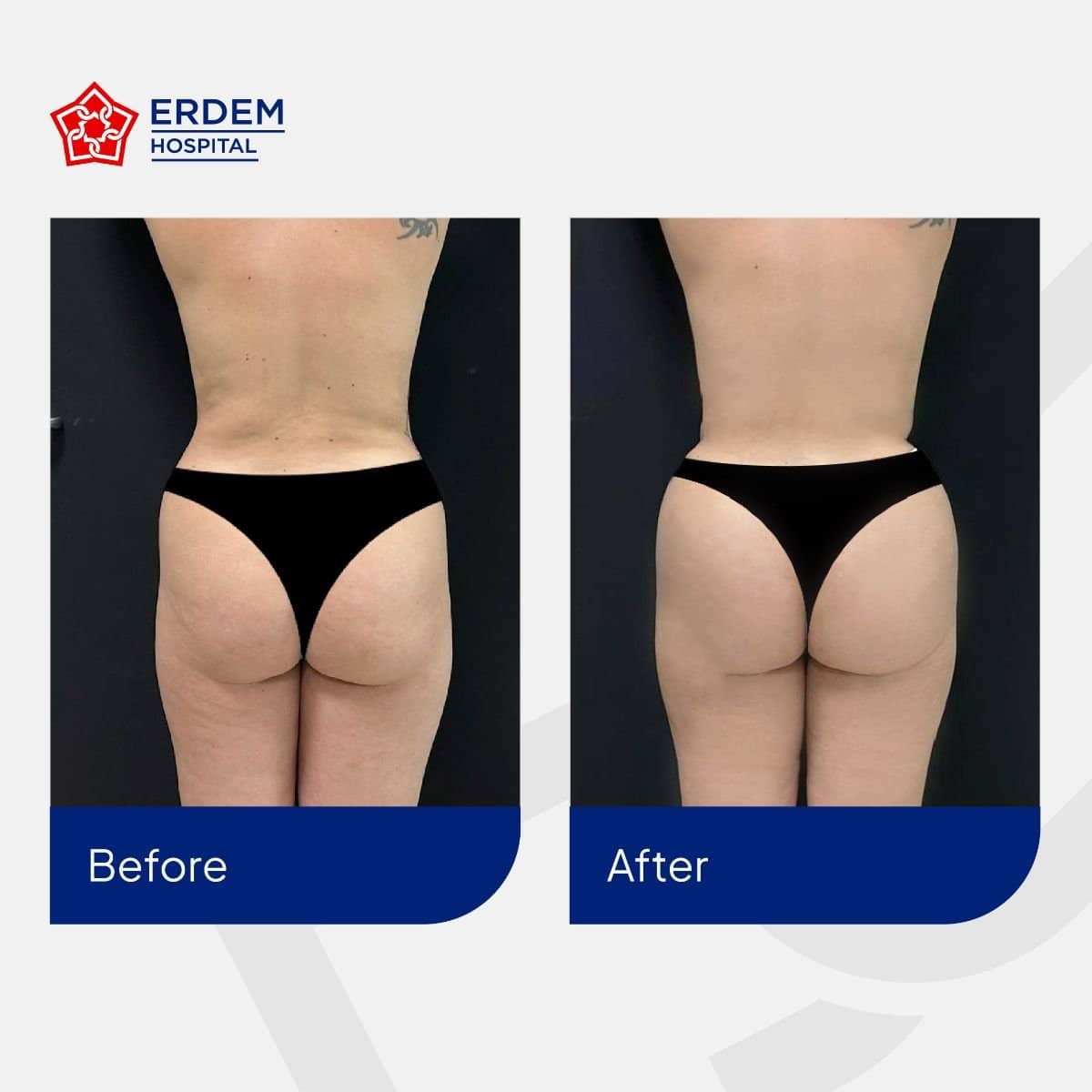Case 14797 - Brazilian Butt Lift