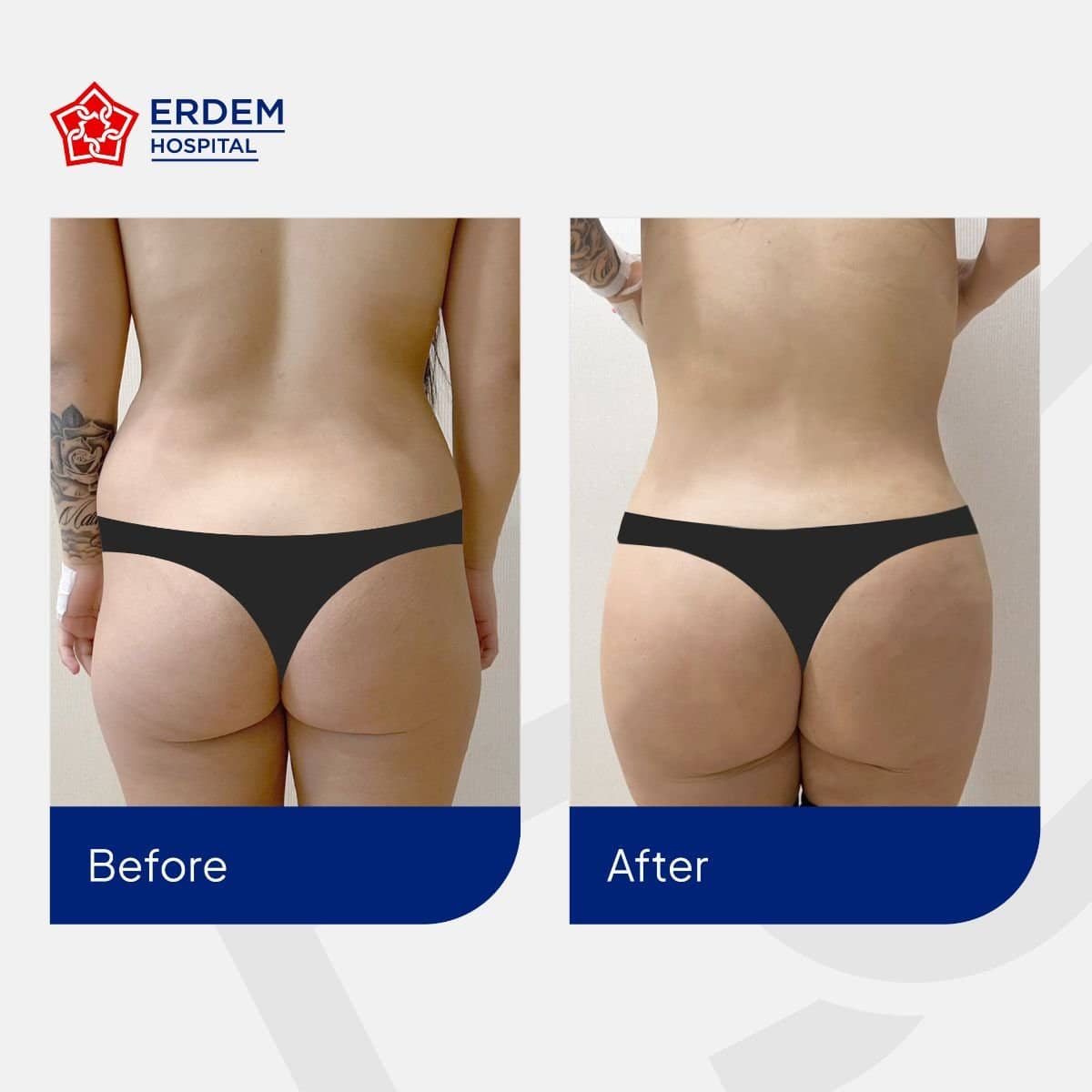 Case 14798 - Brazilian Butt Lift