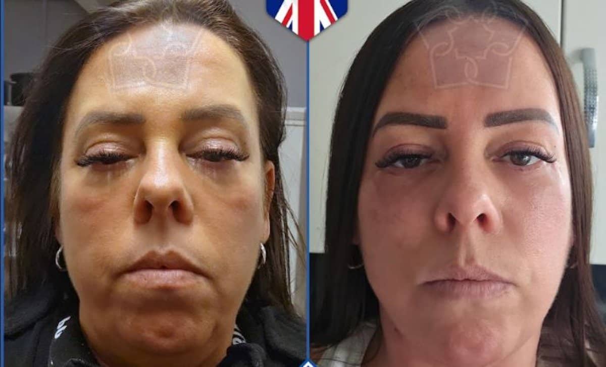 Case 14799 - blepharoplasty