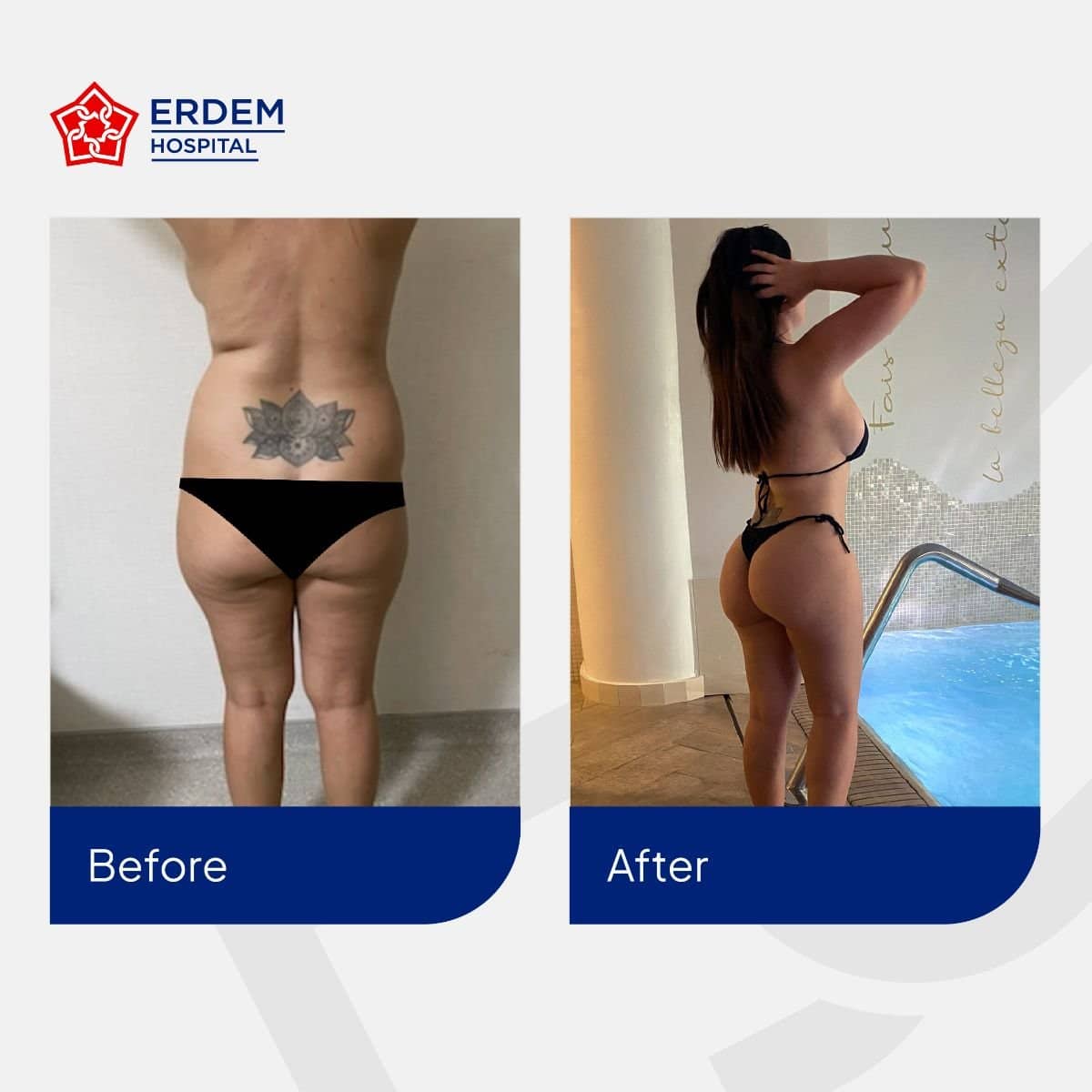 Case 14800 - Brazilian Butt Lift