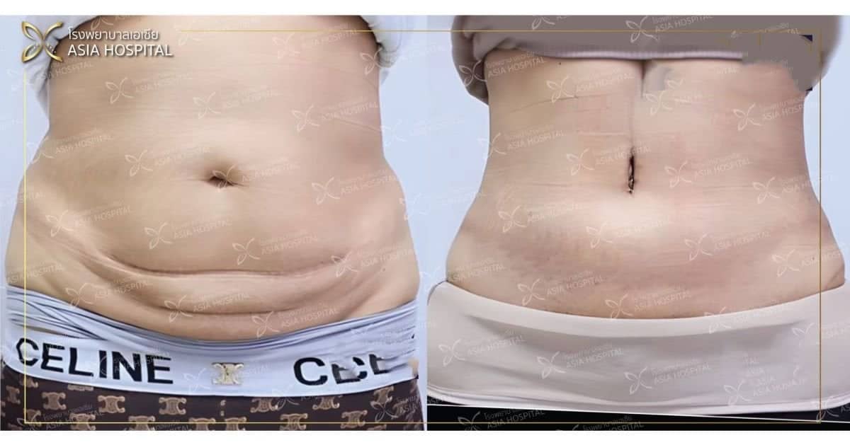 Case 14802 - tummy tuck
