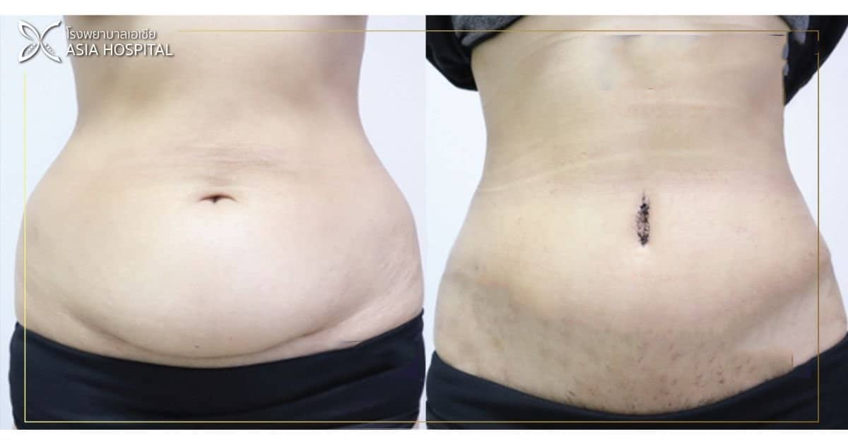 Case 14803 - tummy tuck