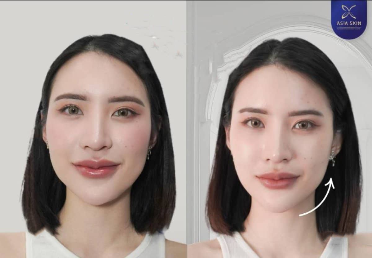Case 14804 - nonsurgical facelift