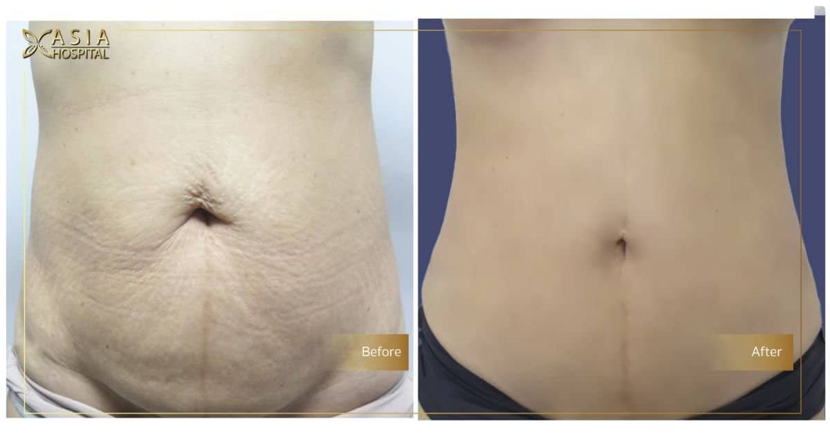 Case 14805 - tummy tuck