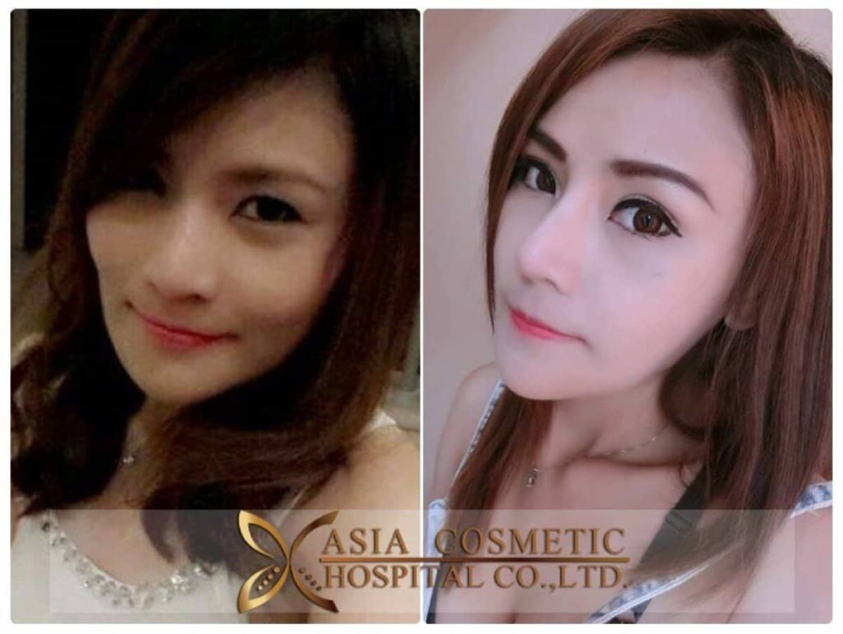 Case 14806 - Botox injections