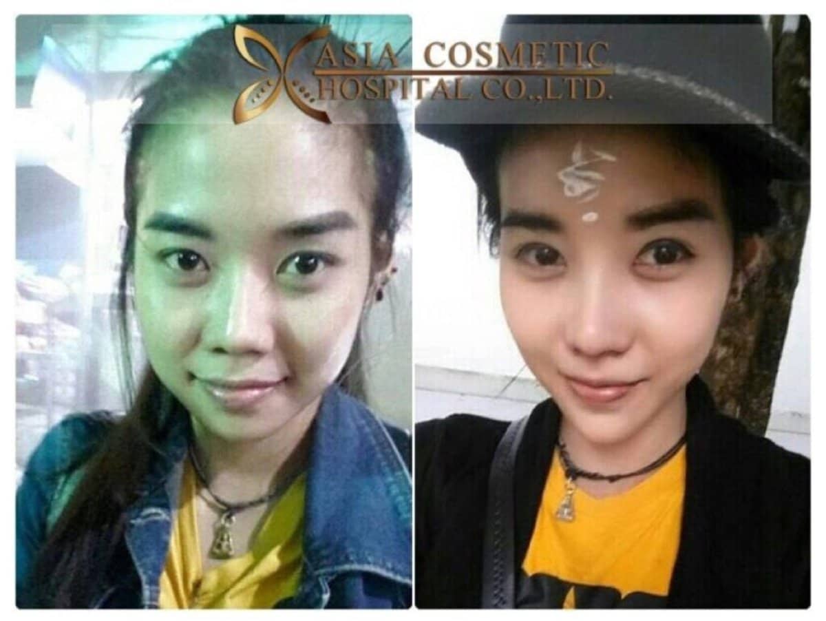 Case 14807 - Botox injections