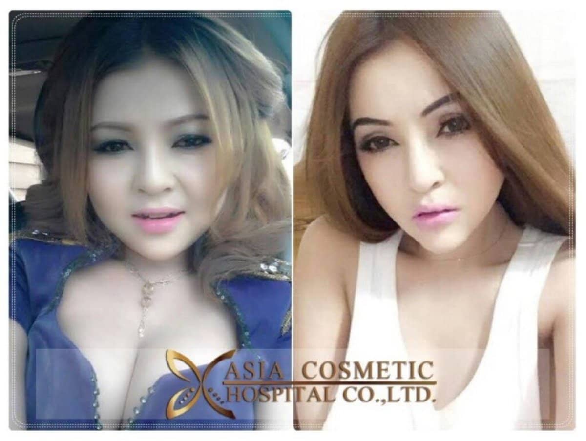 Case 14808 - Botox injections