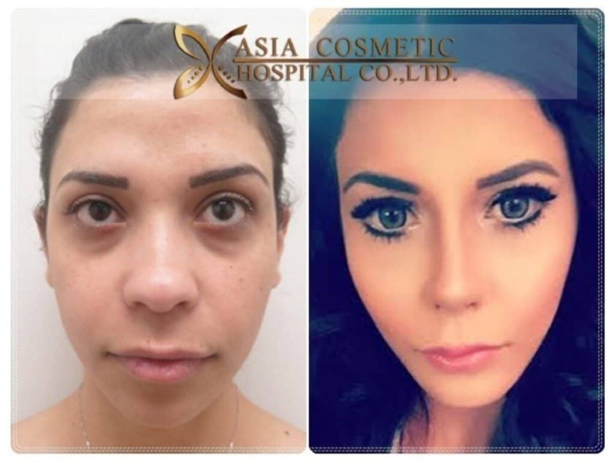 Case 14809 - Botox injections