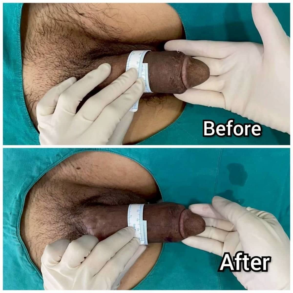 Case 14821 - penile curvature correction