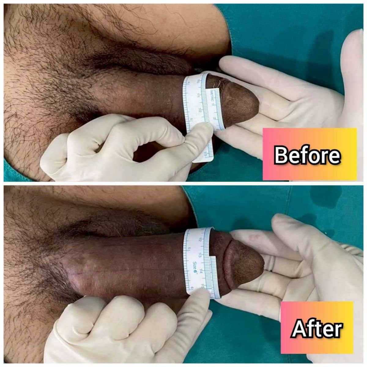 Case 14822 - penile curvature correction