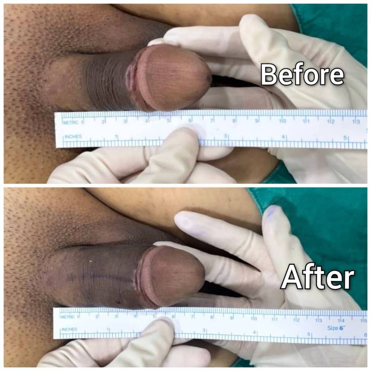 Case 14832 - penile curvature correction