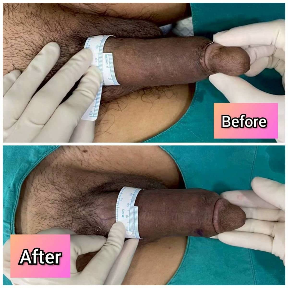 Case 14833 - penile curvature correction