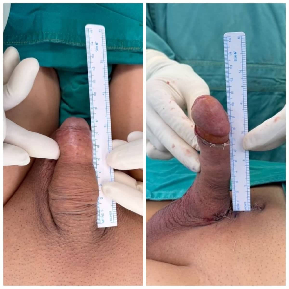 Case 14846 - penile implant surgery