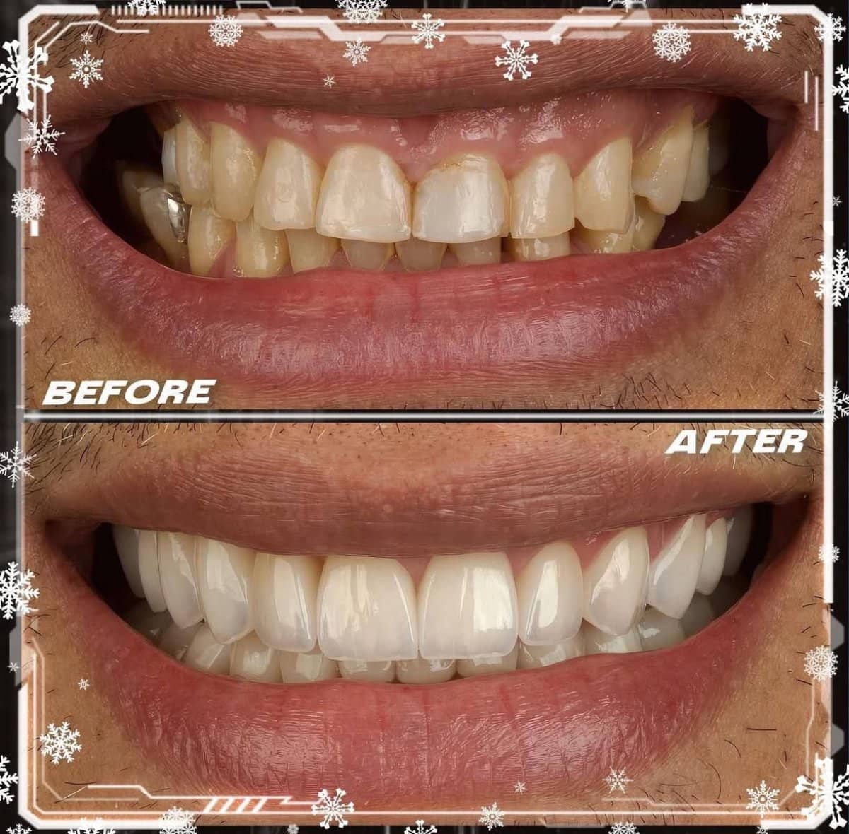 Case 14853 - dental veneers