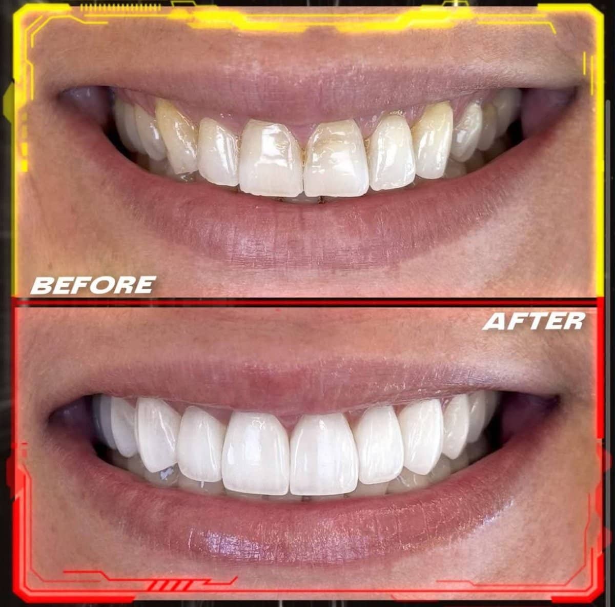 Case 14856 - dental veneers