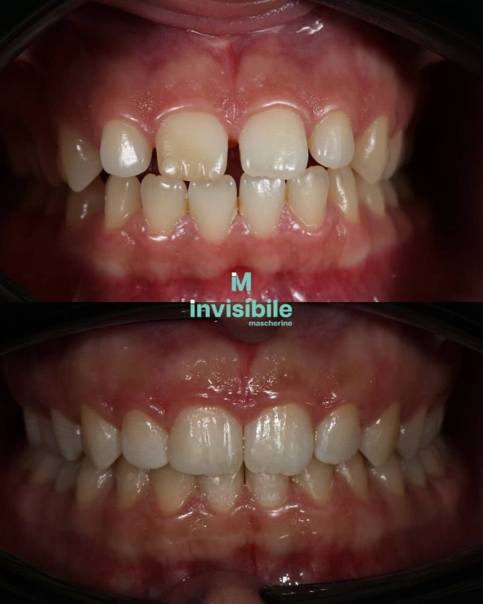 Case 14891 - Invisalign