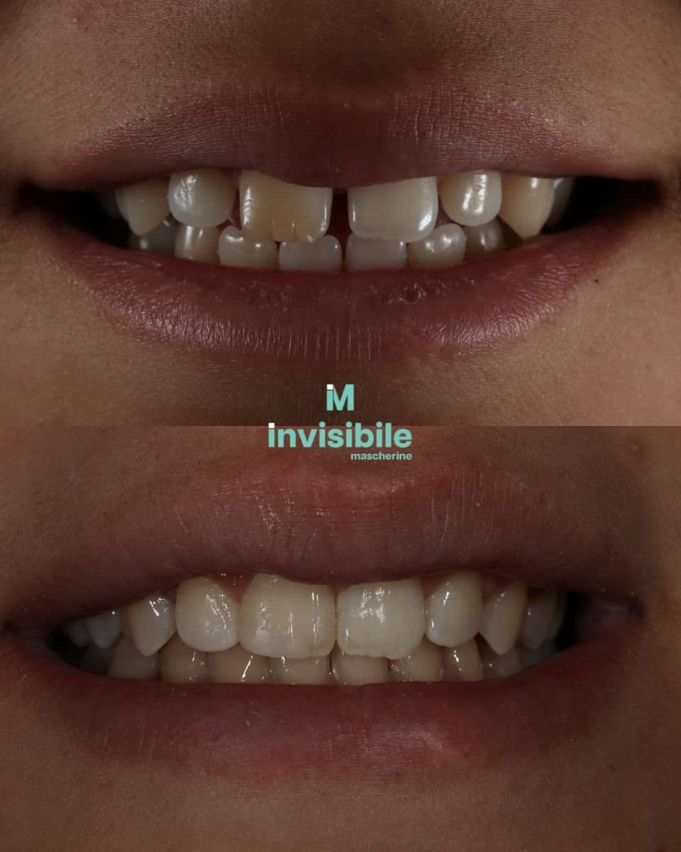 Case 14894 - Invisalign