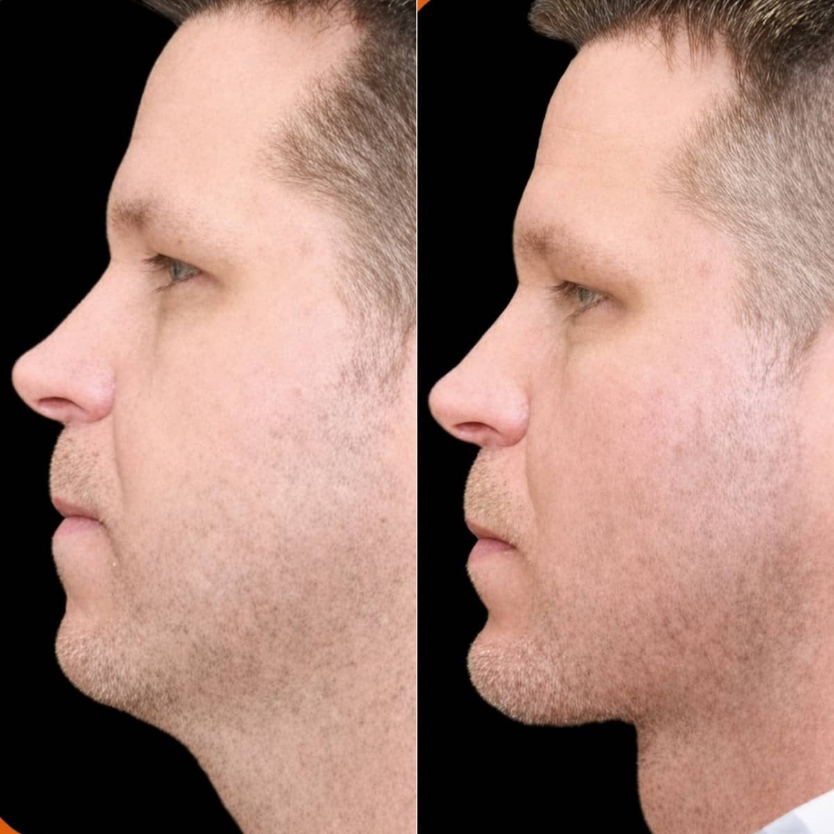 Case 14916 - chin implant