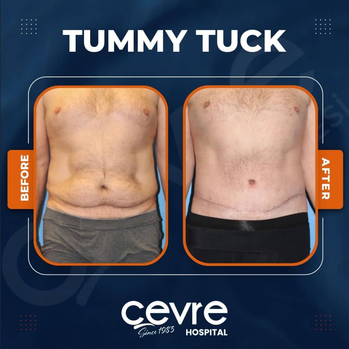 Case 14917 - tummy tuck