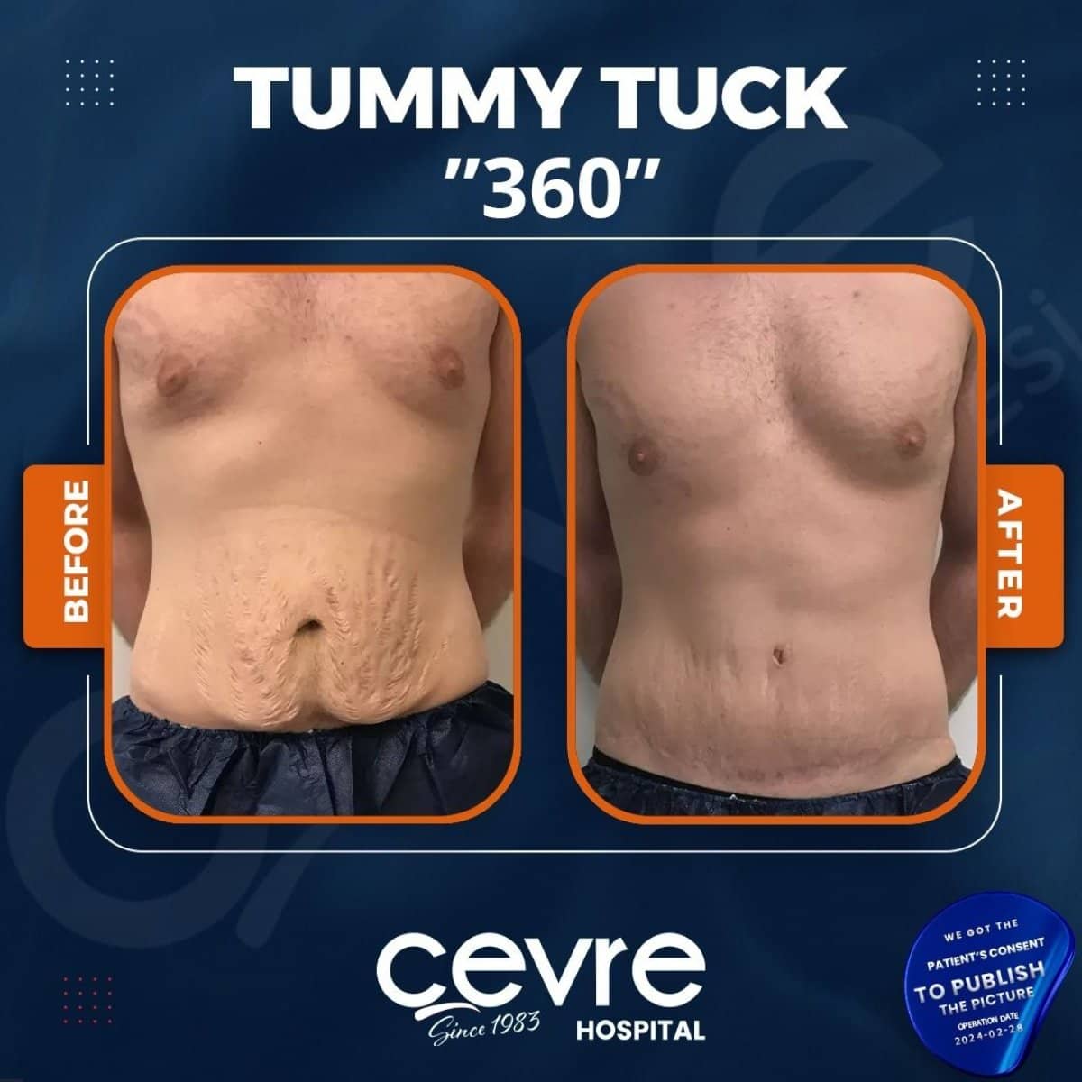 Case 14918 - tummy tuck 360
