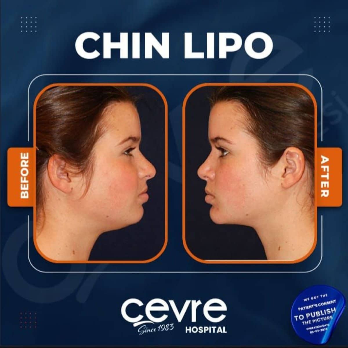 Case 14920 - chin liposuction