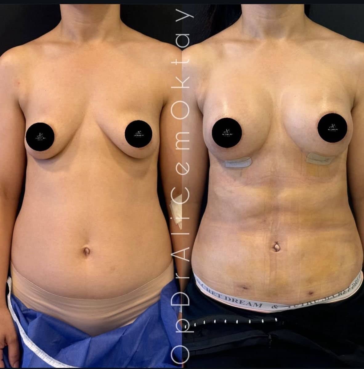 Case 14921 - tummy tuck