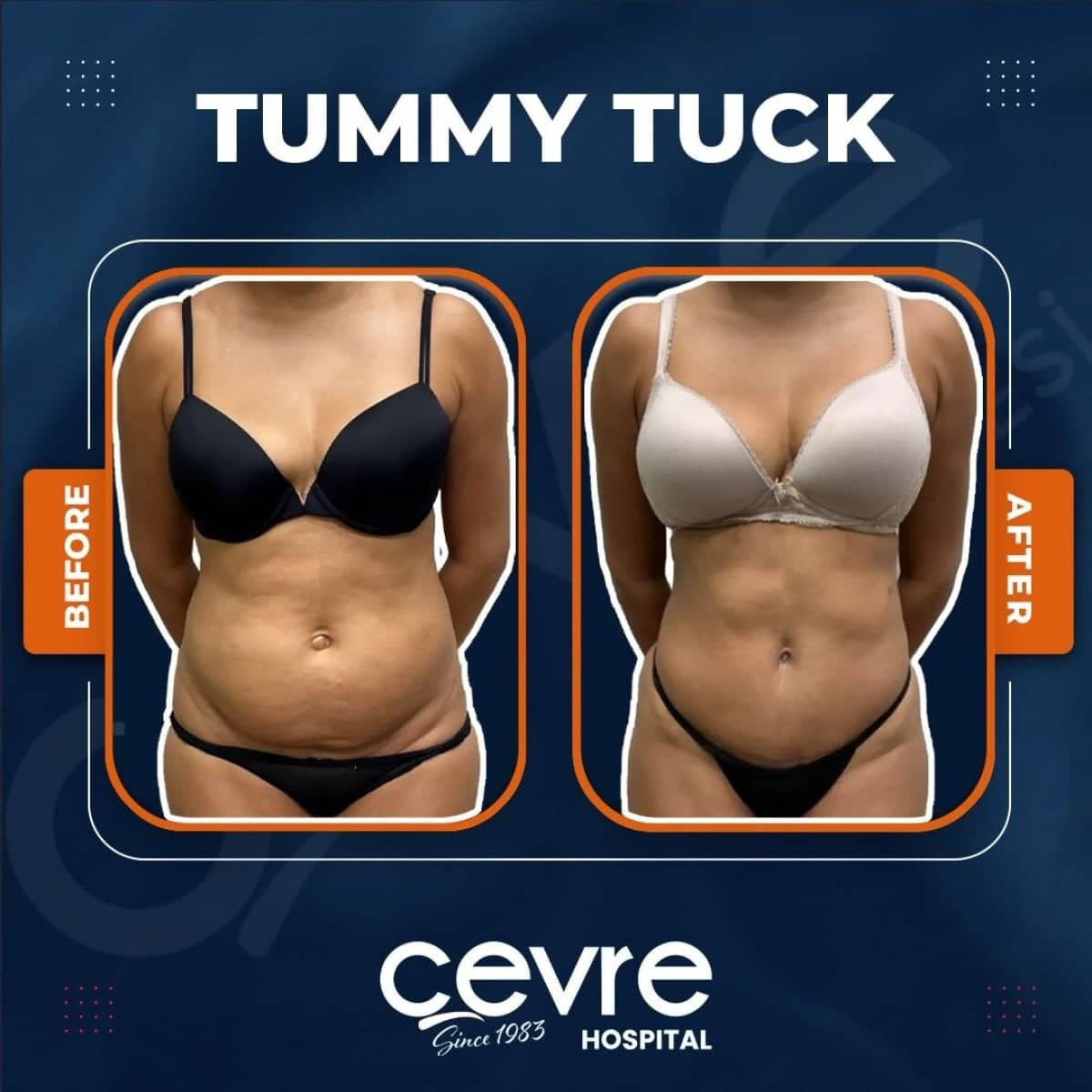 Case 14922 - mommy makeover