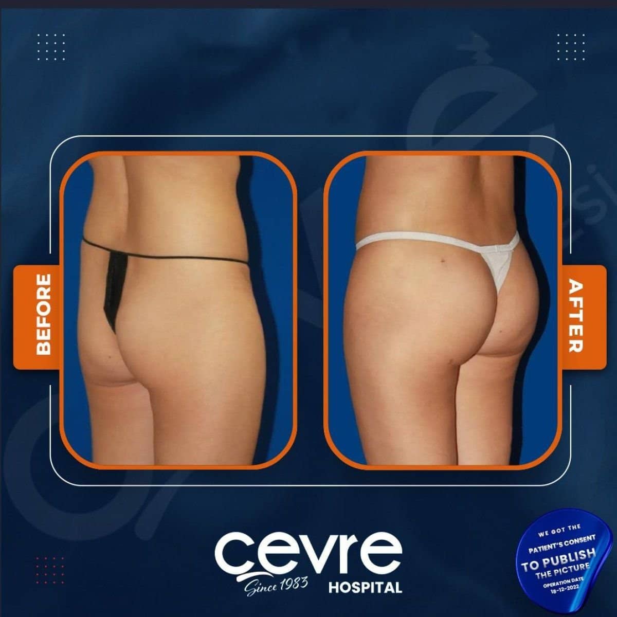 Case 14923 - Brazilian Butt Lift
