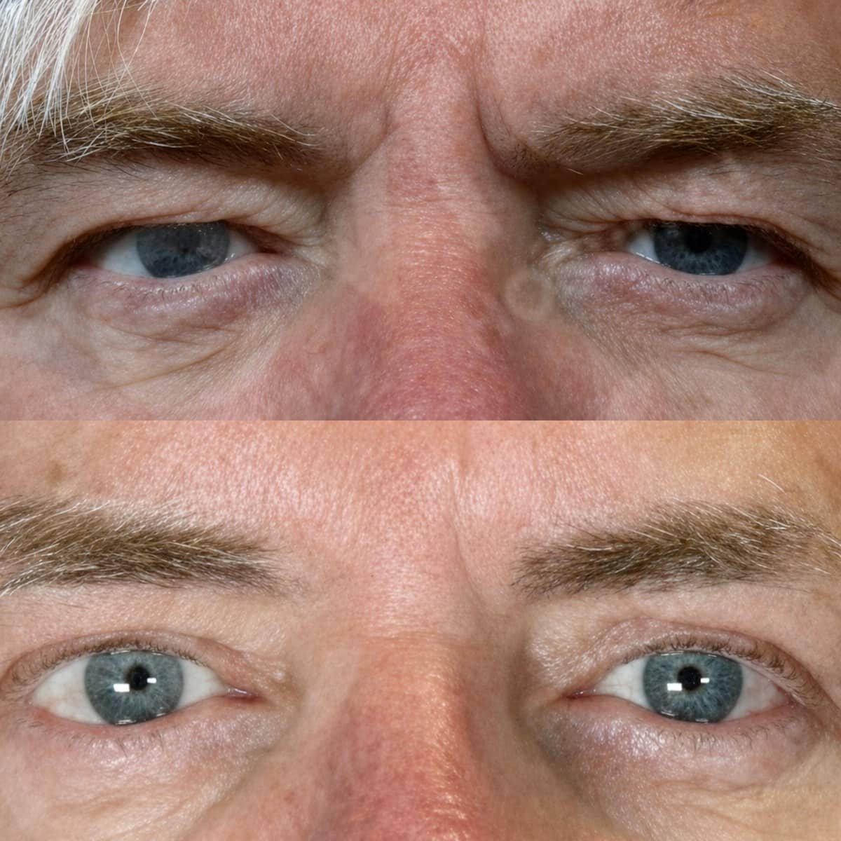 Case 14924 - blepharoplasty