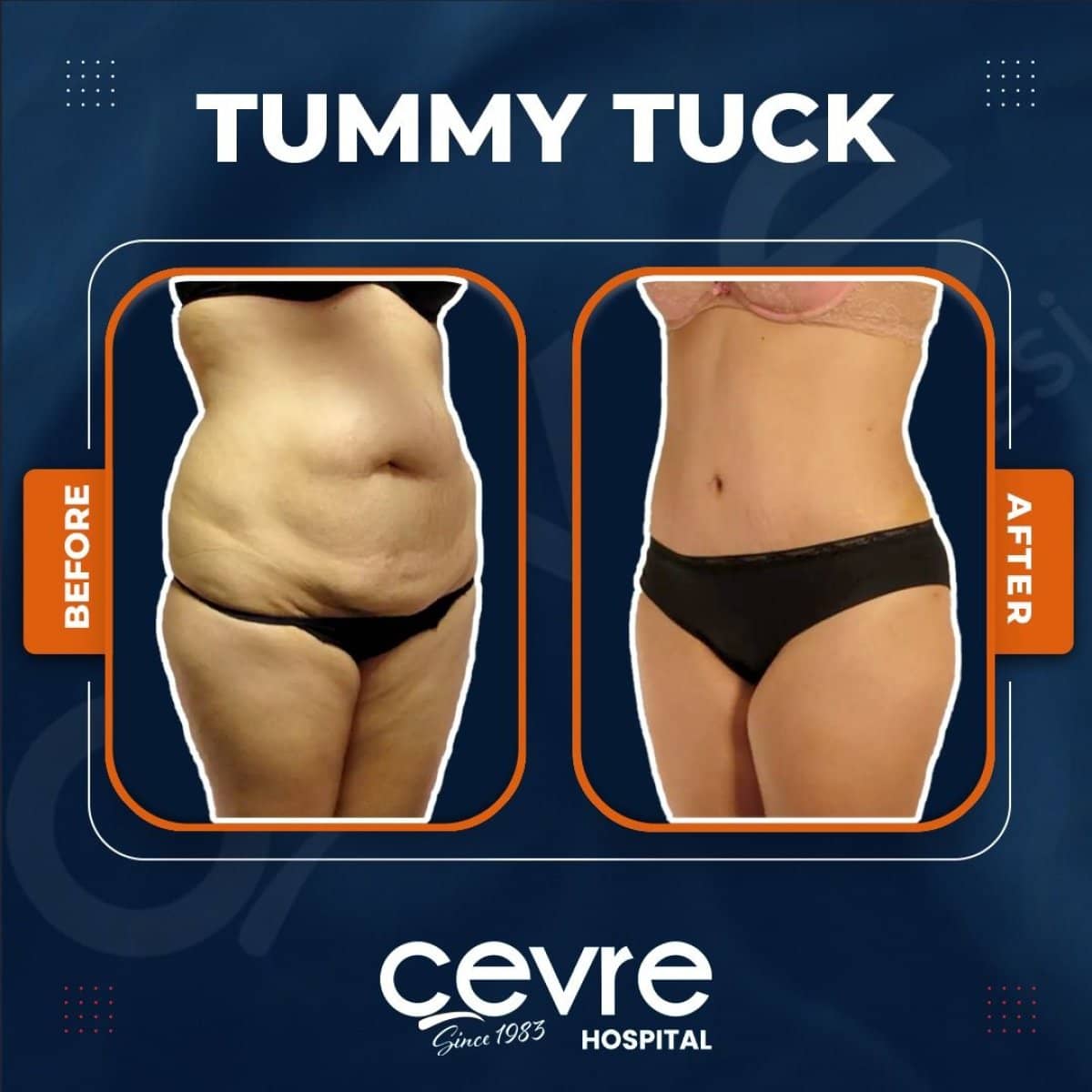 Case 14925 - tummy tuck