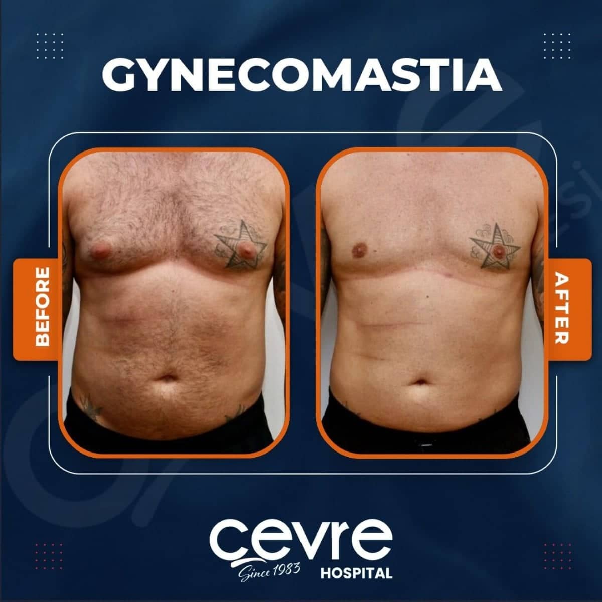 Case 14926 - gynecomastia surgery