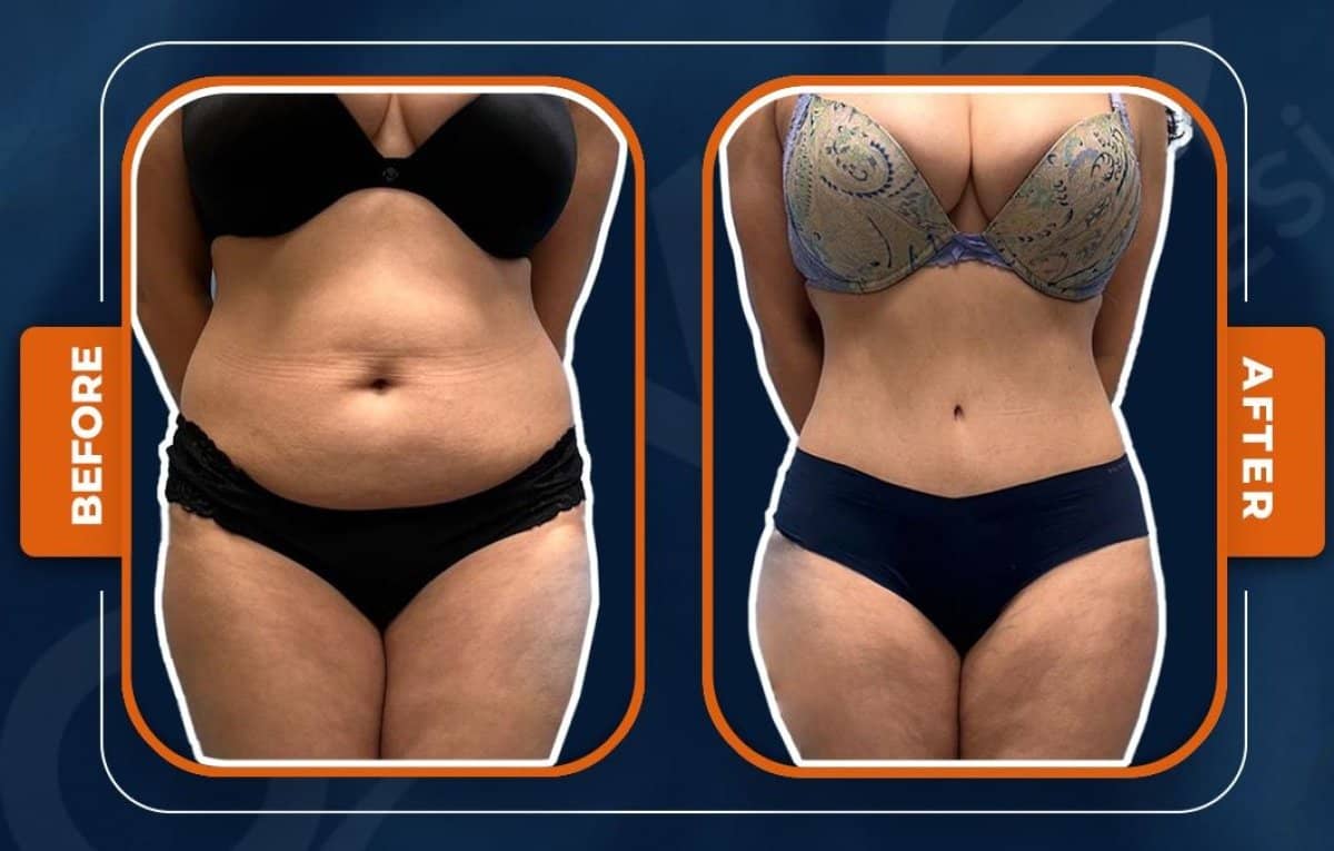 Case 14928 - liposuction