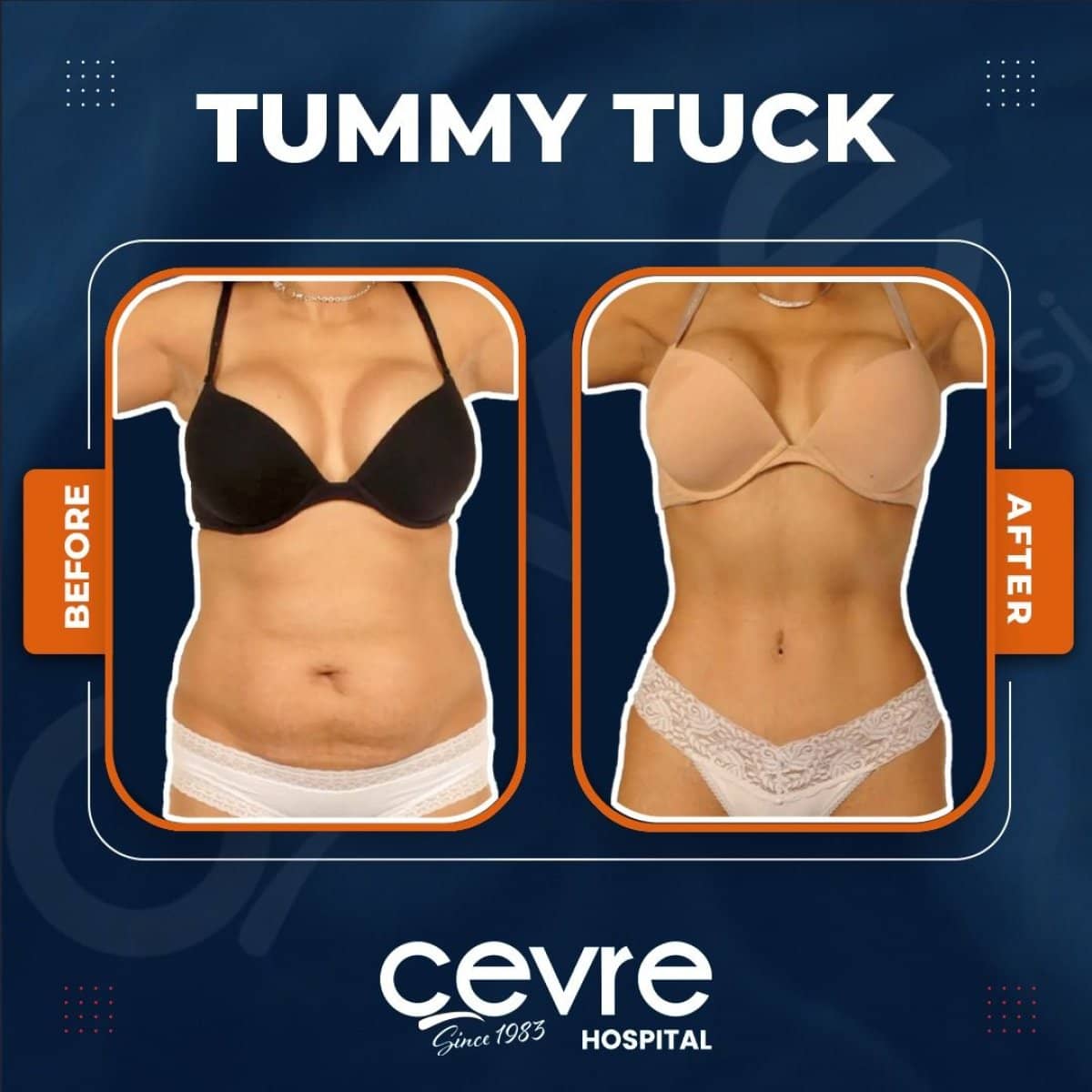 Case 14929 - tummy tuck