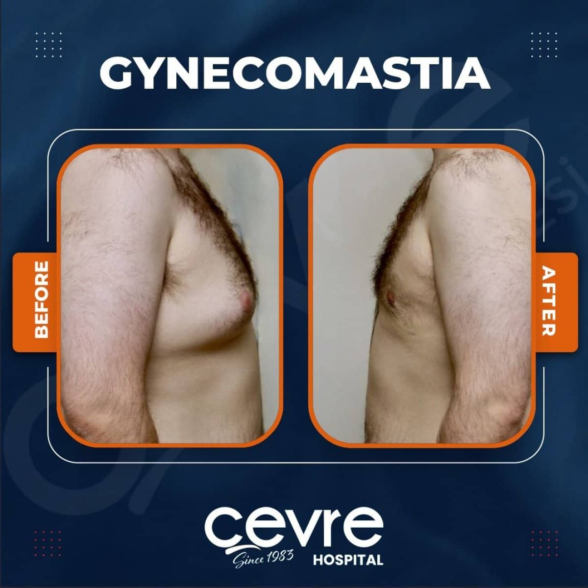 Case 14930 - gynecomastia surgery