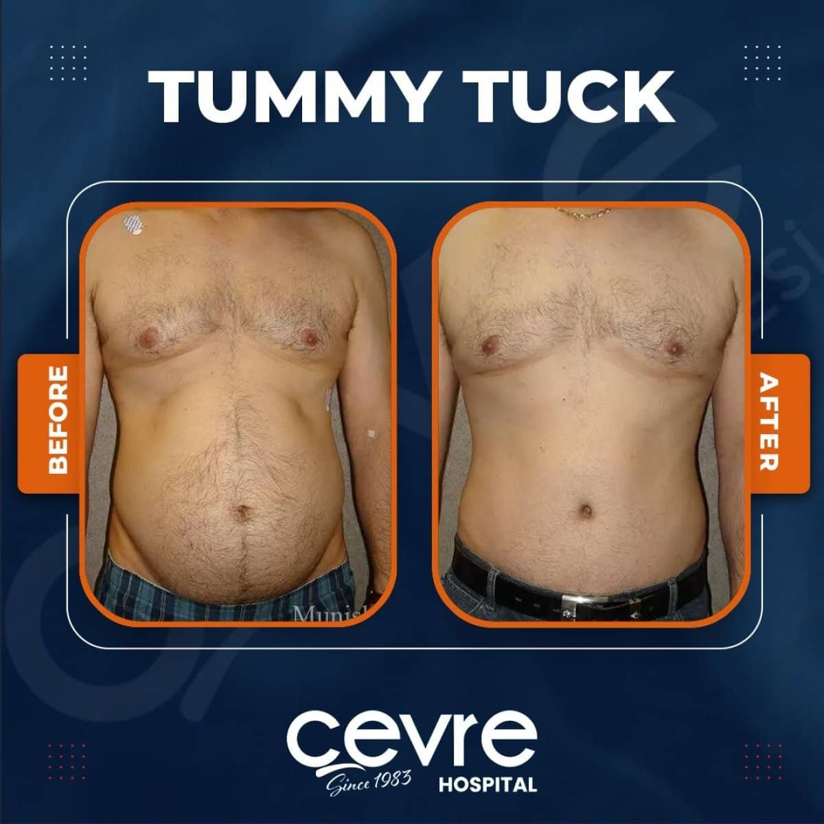 Case 14931 - tummy tuck