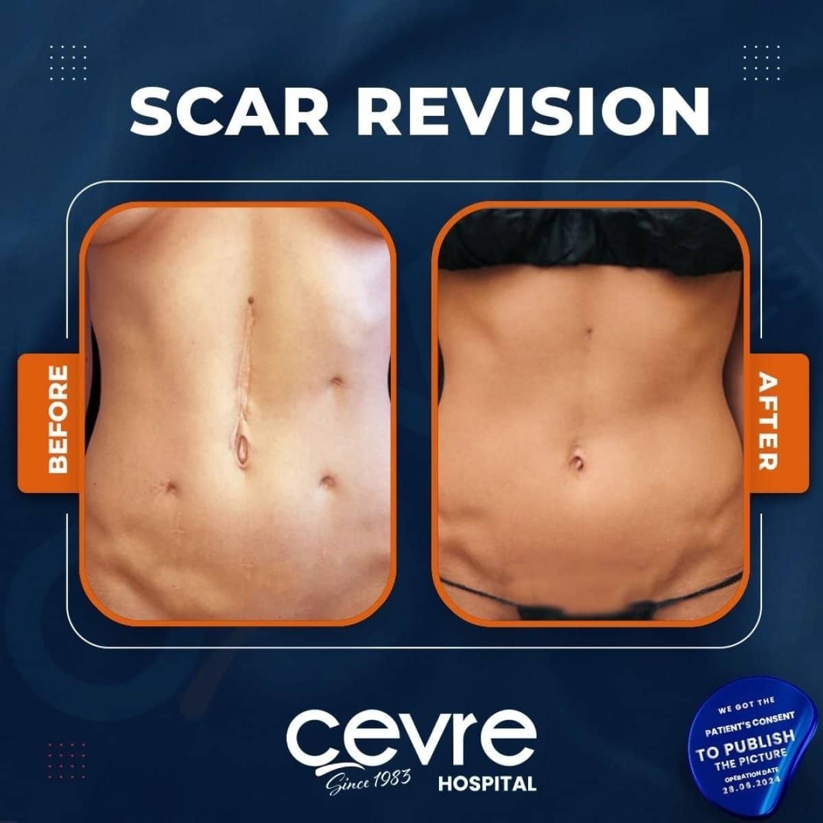 Case 14937 - scar revision