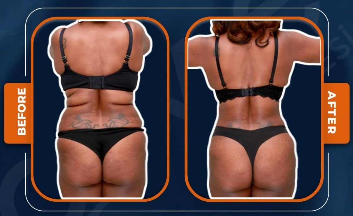 Case 14939 - liposuction