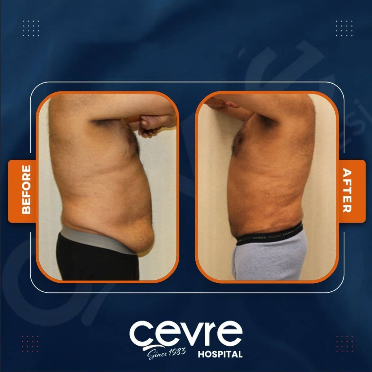 Case 14942 - tummy tuck and liposuction