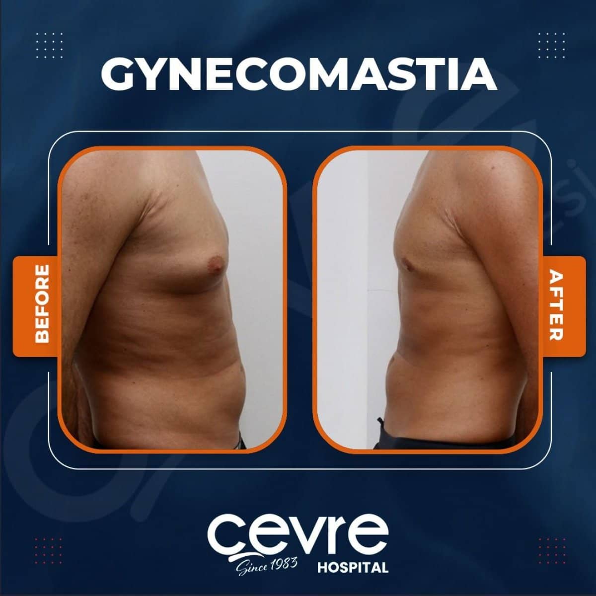 Case 14944 - gynecomastia surgery