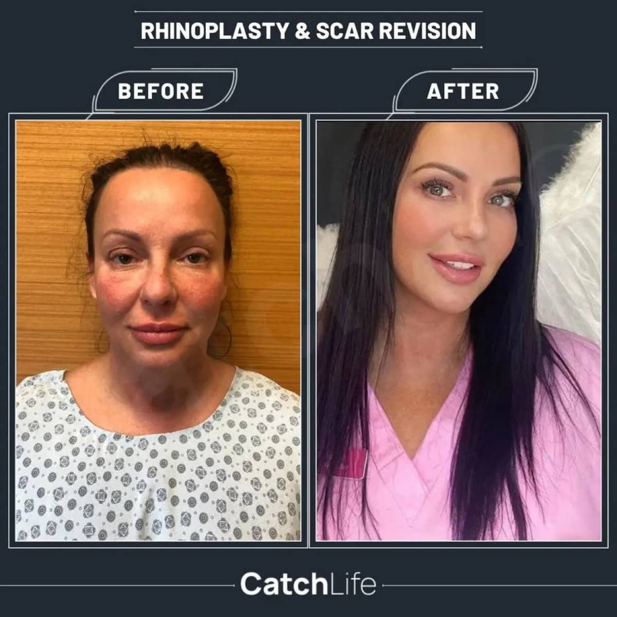 Case 14964 - rhinoplasty and scar revision