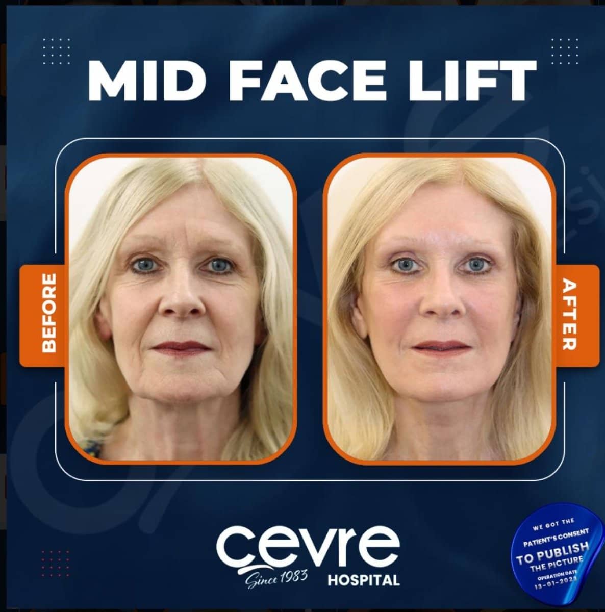 Case 15014 - mid facelift