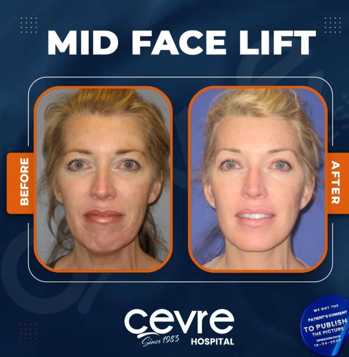 Case 15016 - mid facelift
